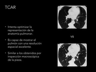 TCAR
• Intenta optimizar la
representación de la
anatomía pulmonar.
• Es capaz de mostrar el
pulmón con una resolución
espacial excelente.
• Similar a los obtenidos por
inspección macroscópica
de la pieza.
vs
 