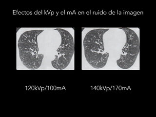 Efectos del kVp y el mA en el ruido de la imagen
120kVp/100mA 140kVp/170mA
 