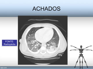 ACHADOS




 FONTE:
Radiopédia
 