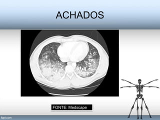 ACHADOS




FONTE: Medscape
 