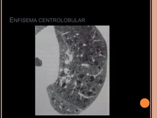 ENFISEMA CENTROLOBULAR
 