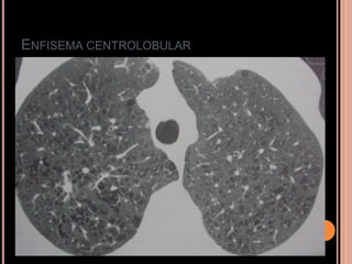 ENFISEMA CENTROLOBULAR
 