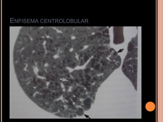ENFISEMA CENTROLOBULAR
 