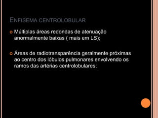 ENFISEMA CENTROLOBULAR
   Múltiplas áreas redondas de atenuação
    anormalmente baixas ( mais em LS);

   Áreas de radiotransparência geralmente próximas
    ao centro dos lóbulos pulmonares envolvendo os
    ramos das artérias centrolobulares;
 