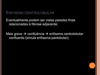 ENFISEMA CENTROLOBULAR
Eventualmente podem ser vistas paredes finas
 relacionadas à fibrose adjacente;

Mais grave  confluência  enfisema centrolobular
 confluente (simula enfisema panlobular);
 