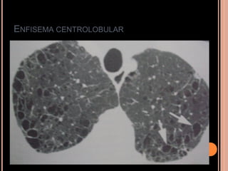 ENFISEMA CENTROLOBULAR
 