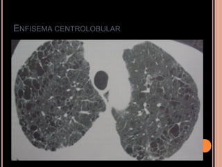 ENFISEMA CENTROLOBULAR
 