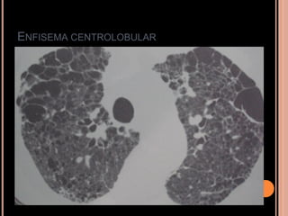 ENFISEMA CENTROLOBULAR
 