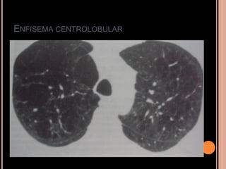 ENFISEMA CENTROLOBULAR
 