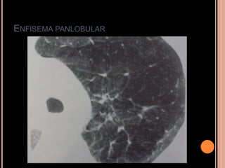 ENFISEMA PANLOBULAR
 