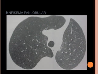 ENFISEMA PANLOBULAR
 