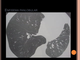 ENFISEMA PANLOBULAR
 