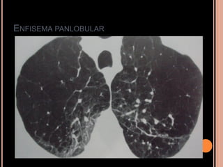 ENFISEMA PANLOBULAR
 