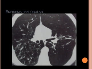 ENFISEMA PANLOBULAR
 