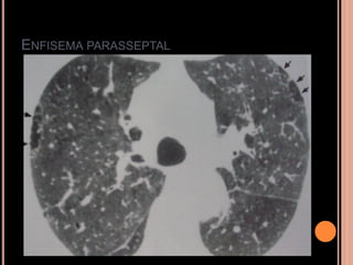 ENFISEMA PARASSEPTAL
 