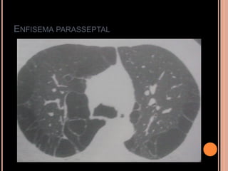 ENFISEMA PARASSEPTAL
 