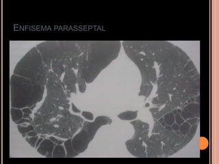ENFISEMA PARASSEPTAL
 