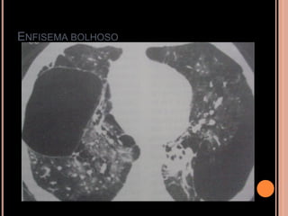 ENFISEMA BOLHOSO
 