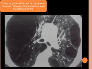 Enfisema grave relacionado ao tabagismo.
Paciente melhorou sintomaticamente após
           bulectomia à direita
 