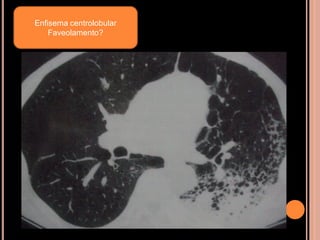 Enfisema centrolobular
    Faveolamento?
 