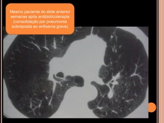 Mesmo paciente do slide anterior
semanas após antibioticoterapia
  (consolidação por pneumonia
 sobreposta ao enfisema grave)
 