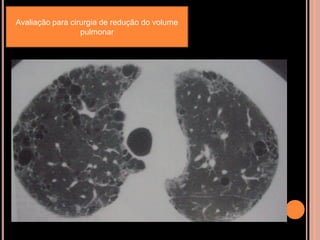 Avaliação para cirurgia de redução do volume
                  pulmonar
 