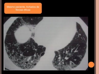 Mesmo paciente. Achados de
      fibrose difusa
 