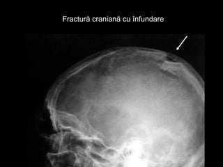 Fractură craniană cu înfundareFractură craniană cu înfundare
 