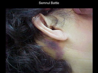 Semnul BattleSemnul Battle
 