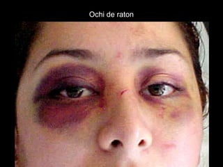 Ochi de ratonOchi de raton
 