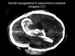Sondă nazogastrică în parenchimul cerebralSondă nazogastrică în parenchimul cerebral
(imagine CT)(imagine CT)
 