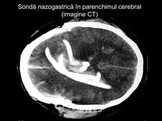 Sondă nazogastrică în parenchimul cerebralSondă nazogastrică în parenchimul cerebral
(imagine CT)(imagine CT)
 