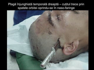 Plagă înjunghiată temporală dreaptă – cuţitul trece prinPlagă înjunghiată temporală dreaptă – cuţitul trece prin
spatele orbitei oprindu-se în naso-faringespatele orbitei oprindu-se în naso-faringe
 