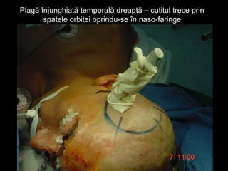 Plagă înjunghiată temporală dreaptă – cuţitul trece prinPlagă înjunghiată temporală dreaptă – cuţitul trece prin
spatele orbitei oprindu-se în naso-faringespatele orbitei oprindu-se în naso-faringe
 