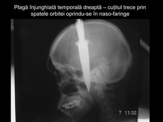 Plagă înjunghiată temporală dreaptă – cuţitul trece prinPlagă înjunghiată temporală dreaptă – cuţitul trece prin
spatele orbitei oprindu-se în naso-faringespatele orbitei oprindu-se în naso-faringe
 