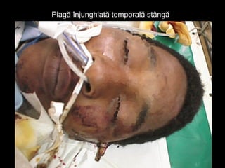 Plagă înjunghiată temporală stângăPlagă înjunghiată temporală stângă
 