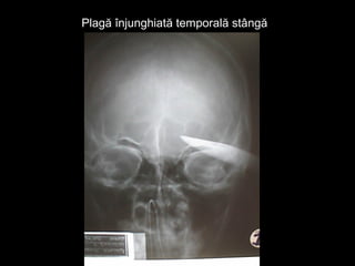 Plagă înjunghiată temporală stângăPlagă înjunghiată temporală stângă
 