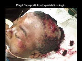 Plagă împuşcată fronto-parietală stângăPlagă împuşcată fronto-parietală stângă
 