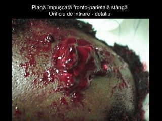 Plagă împuşcată fronto-parietală stângăPlagă împuşcată fronto-parietală stângă
Orificiu de intrare - detaliuOrificiu de intrare - detaliu
 