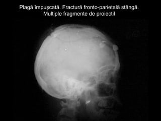 Plagă împuşcată. Fractură fronto-parietală stângă.Plagă împuşcată. Fractură fronto-parietală stângă.
Multiple fragmente de proiectilMultiple fragmente de proiectil
 