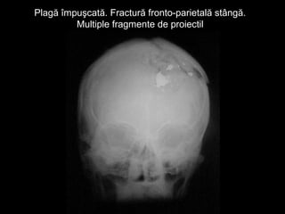 Plagă împuşcată. Fractură fronto-parietală stângă.Plagă împuşcată. Fractură fronto-parietală stângă.
Multiple fragmente de proiectilMultiple fragmente de proiectil
 
