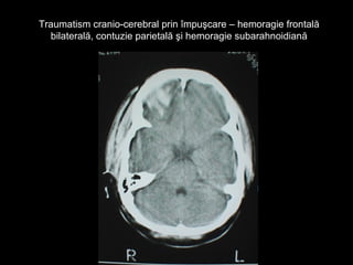 Traumatism cranio-cerebral prin împuşcare – hemoragie frontalăTraumatism cranio-cerebral prin împuşcare – hemoragie frontală
bilaterală, contuzie parietală şi hemoragie subarahnoidianăbilaterală, contuzie parietală şi hemoragie subarahnoidiană
 