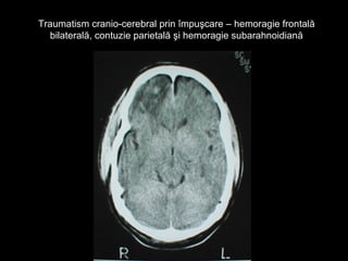 Traumatism cranio-cerebral prin împuşcare – hemoragie frontalăTraumatism cranio-cerebral prin împuşcare – hemoragie frontală
bilaterală, contuzie parietală şi hemoragie subarahnoidianăbilaterală, contuzie parietală şi hemoragie subarahnoidiană
 
