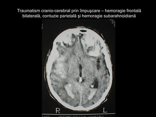 Traumatism cranio-cerebral prin împuşcare – hemoragie frontalăTraumatism cranio-cerebral prin împuşcare – hemoragie frontală
bilaterală, contuzie parietală şi hemoragie subarahnoidianăbilaterală, contuzie parietală şi hemoragie subarahnoidiană
 