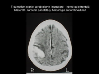 Traumatism cranio-cerebral prin împuşcare – hemoragie frontalăTraumatism cranio-cerebral prin împuşcare – hemoragie frontală
bilaterală, contuzie parietală şi hemoragie subarahnoidianăbilaterală, contuzie parietală şi hemoragie subarahnoidiană
 