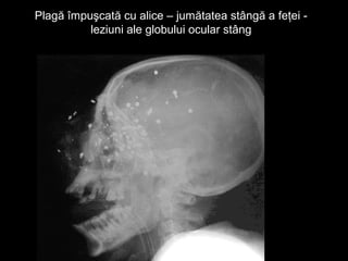 Plagă împuşcată cu alice – jumătatea stângă a feţei -Plagă împuşcată cu alice – jumătatea stângă a feţei -
leziuni ale globului ocular stângleziuni ale globului ocular stâng
 