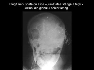 Plagă împuşcată cu alice – jumătatea stângă a feţei -Plagă împuşcată cu alice – jumătatea stângă a feţei -
leziuni ale globului ocular stângleziuni ale globului ocular stâng
 
