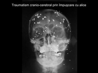 Traumatism cranio-cerebral prin împuşcare cu aliceTraumatism cranio-cerebral prin împuşcare cu alice
 