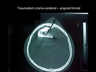 Traumatism cranio-cerebral – şrapnel frontalTraumatism cranio-cerebral – şrapnel frontal
 