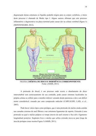 14

degeneração destas estruturas os líquidos poderão migrar para os corpos vertebrais, o início
deste processo é chamado de Modic tipo I. Alguns autores afirmam que este processo
inflamatório e degenerativo na placa terminal pode causar dor na coluna vertebral (figura 1)
(MONTENEGRO, 2012).

FIGURA 2 HÉRNIA DE DISCO E DORMÊNCIA CORRESPONDENTE
Fonte: (ASSIS, 2011)

A protrusão do discal, é um processo onde ocorre o abaulamento do disco
intervertebral sem extravasamento do seu conteúdo, pode causar sintomas localizados na
própria coluna ou refletir para o membro inferior variando desde parestesia e dor a um déficit
motor considerável, causado por uma compressão radicular (CARVALHO, LAIS, et al.,
2007).
Pode haver vários tipos como prolapso, que é uma protrusão do núcleo ainda contida
nas camadas externas do anel fibroso e nas estruturas ligamentar de suporte. Extrusão é uma
protrusão na qual o núcleo pulposo se rompe através do anel externo e fica sob o ligamento
longitudinal posterior. Seqüestro livre o núcleo que sofreu extrusão move-se para longe da
área do prolapso como mostra Figura 3 (ASSIS, 2011).

 